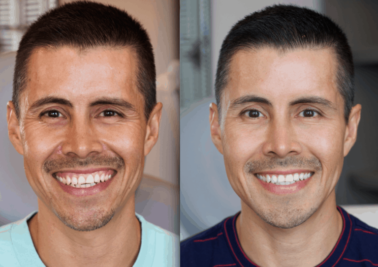 Gummy Smile before and after