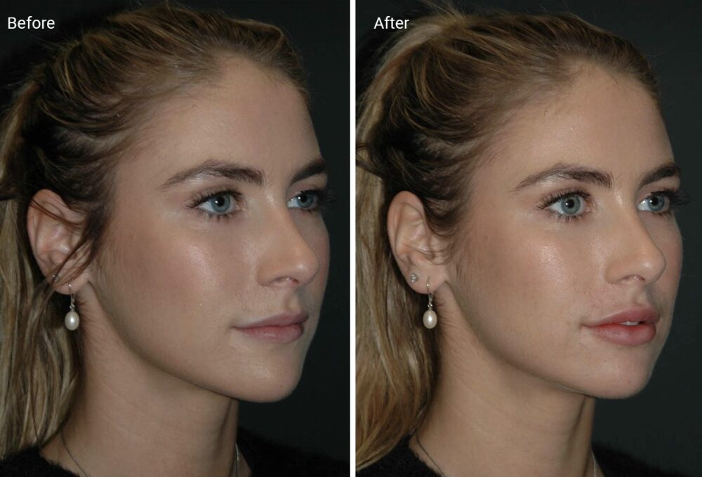 Lip fillers before and after