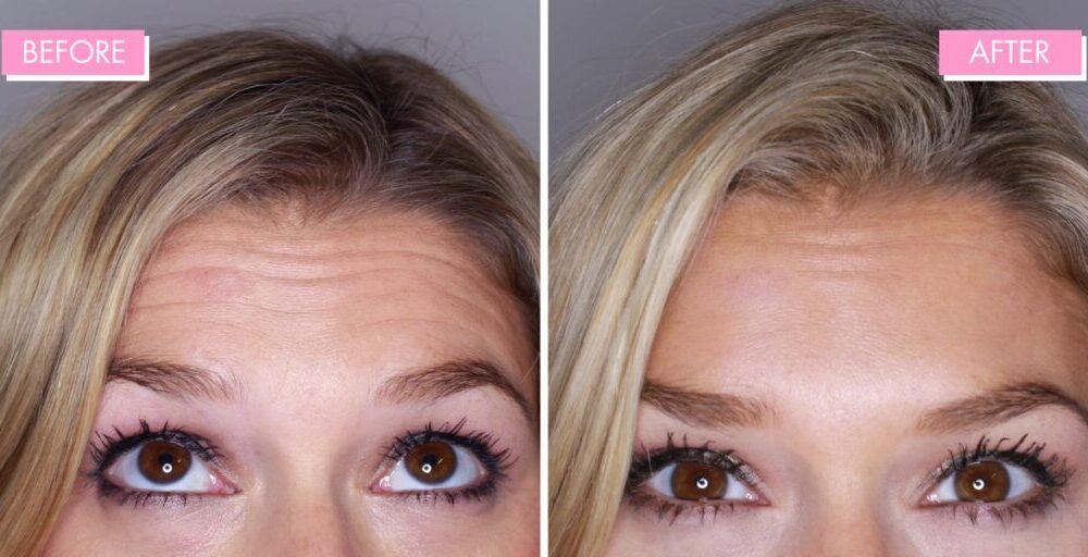 Botox before and after