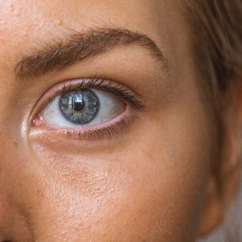 Botox for Crow’s Feet